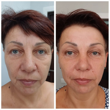 Фото до та після одного букального масажу