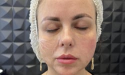 Коллагеностимулююча процедура з гідроксиаппатитом кальцію Косметолог-инъекционист Татьяна Мукачево