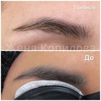 видалення татуажу брів з багаторазовими перекриттями