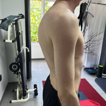 Кіфоз.До лікування.