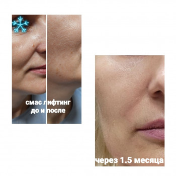  
Коррекция носогубной складки
До.после и через 1.5 месяца после смас лифтинга 
оригинальная Ulthera