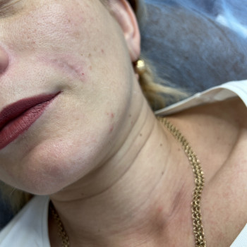 Коррекція носогубних складок
                    Косметолог-ін'єкціоніст Любов Запоріжжя