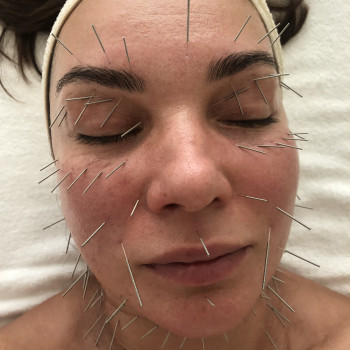 Face Lifting Acupuncture (голки)
                    Масажист Николай Київ