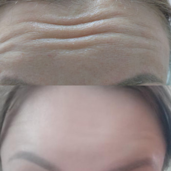 Після однієї процедури.