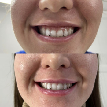 Корекція десневої посмішки