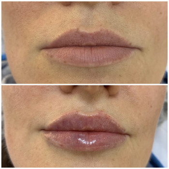 Контурна пластика губ
                    Врач-косметолог Юлия Киев