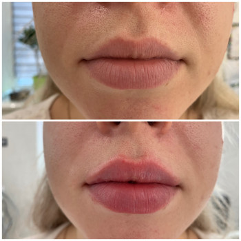 Контурна пластика губ
                    Врач-косметолог Юлия Киев