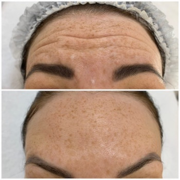 Ботулінотерапія
                    Врач-косметолог Юлия Киев