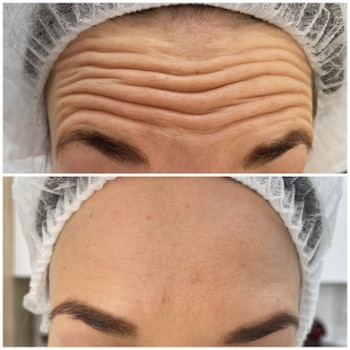 Ботулінотерапія
                    Врач-косметолог Юлия Киев