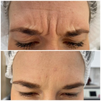 Ботулінотерапія
                    Врач-косметолог Юлия Киев