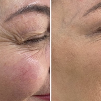 Ботулінотерапія
                    Врач-косметолог Юлия Киев