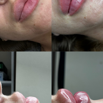 Збільшення губ