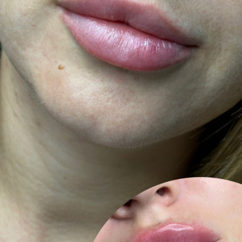 Збільшення губ