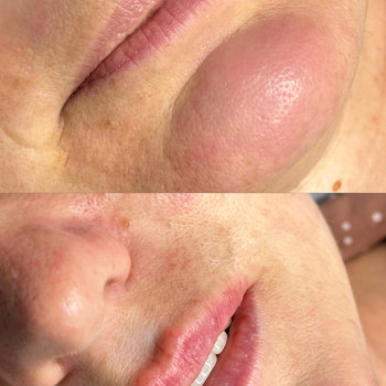 Збільшення губ