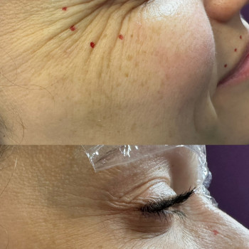 ботулінотерапія