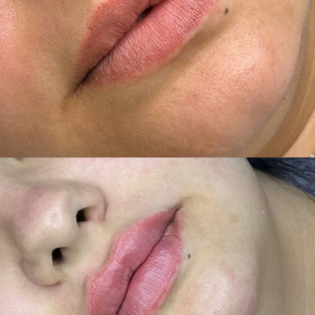 збільшення губ