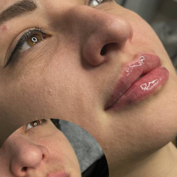 збільшення губ