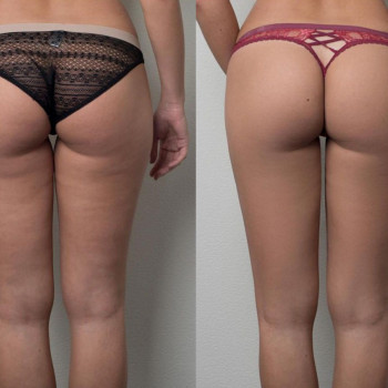 Корекція фігури апаратний масаж тіла, фото - масажний салон Body Icon Studio