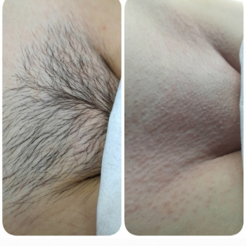 Бікіні до і после