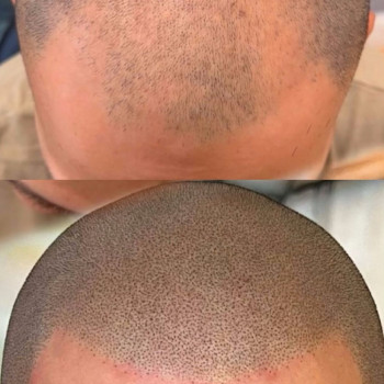 Трихопигментация
                    Мастер перманентного макияжа Анна Киев