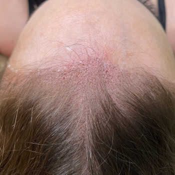 Трихопигментация
                    Мастер перманентного макияжа Анна Киев