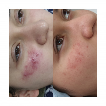 Лікування розацея