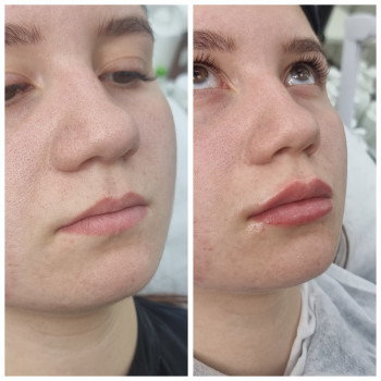 Контурна пластика губ