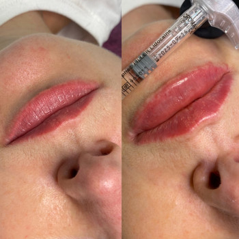 Контурна пластика губ
                    Косметолог Людмила Киев