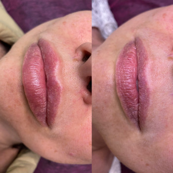 Контурна пластика губ
                    Косметолог Людмила Киев