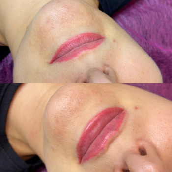 Контурна пластика губ
                    Косметолог Людмила Киев