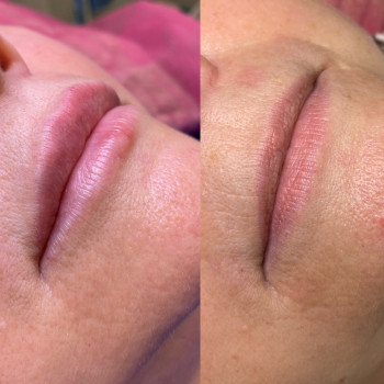 Контурна пластика губ
                    Косметолог Людмила Киев