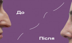 Ринопластика Медичний центр  Луцьк