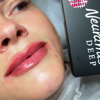 Демократичний Neuramis deep