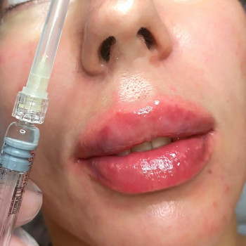 Філер-Біоревіталізант
Revofill plus