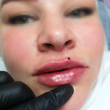 Демократичний Neuramis deep