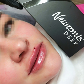 Демократичний Neuramis deep