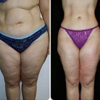 Лазерна ліпосакція
                    Косметологический центр WE Cosmetology Одесса