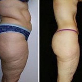 Лазерна ліпосакція
                    Косметологический центр WE Cosmetology Одесса