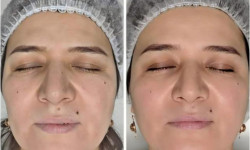 Мікротокова терапія обличчя Косметологічний центр WE Cosmetology Київ