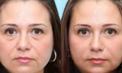 Мікротокова терапія периорбітальної зони Косметологический центр WE Cosmetology Одесса