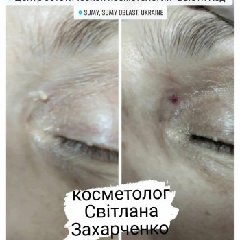 усунення косметичного недоліку обличчя - 