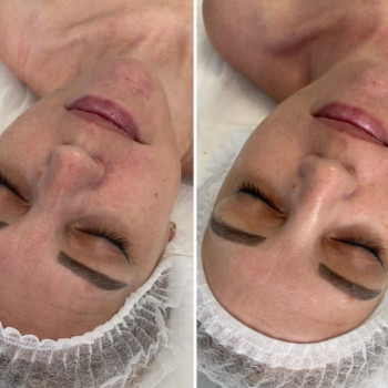 Ферментотерапія ENZYM-OXY SYSTEM
                    Косметологічний центр WE Cosmetology Одеса