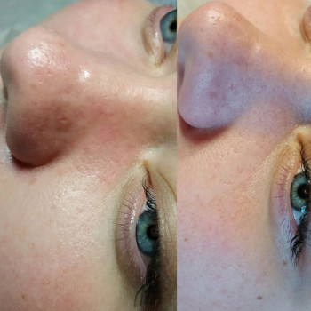 Комбінована чистка обличчя (апаратна+механічна+догляд)
                    Косметологический центр WE Cosmetology Одесса