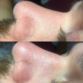 Комбінована чистка обличчя (апаратна+механічна+догляд)
                    Косметологический центр WE Cosmetology Одесса