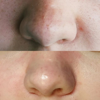 Комбінована чистка обличчя (апаратна+механічна+догляд)
                    Косметологический центр WE Cosmetology Одесса