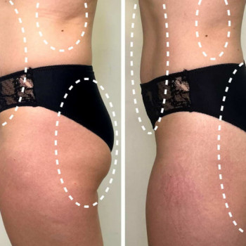 RF ліфтинг тіла
                    Косметологический центр  Киев