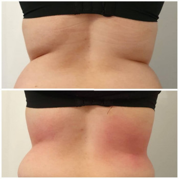 Активна програма корекції фігури (кавітація+вакуумний масаж+рф-ліфтинг)
                    Косметологічний центр WE Cosmetology Одеса