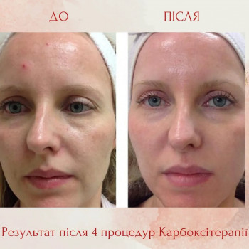 Апаратна карбоксітерапія
                    Косметолог-естетист Виктория Київ