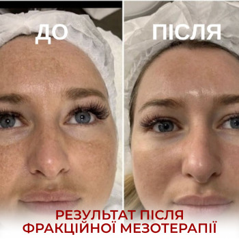 Фракційна мезоторапія (Мікронідлінг)
                    Косметолог-естетист Виктория Київ