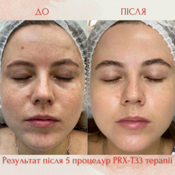 Пілінг PRX-T33
                    Косметолог-естетист Виктория Київ